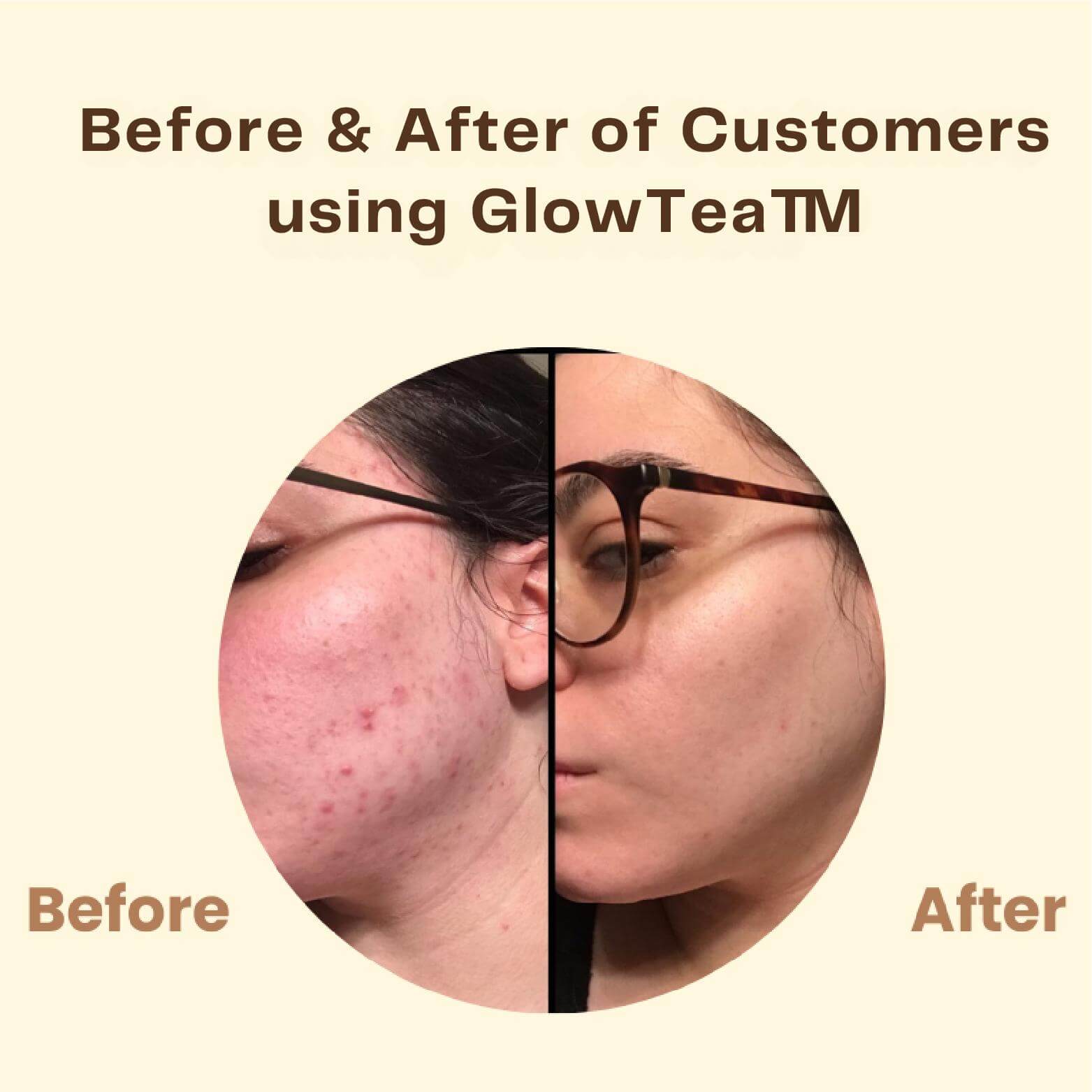 Dernier Jour - 50% de Réduction 🔥 | Masque au Thé Noir GlowTea™